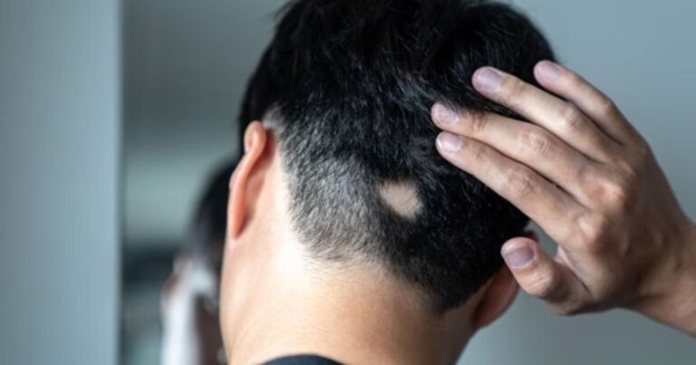 Así funciona el primer medicamento contra la alopecia y la calvicie masculina en adolescentes: duración y dosis recomendada
