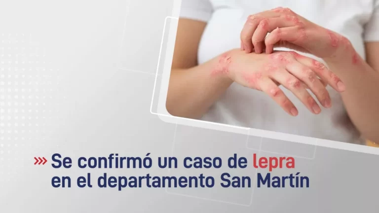 Se confirmó un caso de lepra en el departamento San Martín