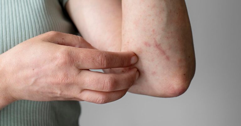 ¿Qué es la culebrilla y por qué aparece?