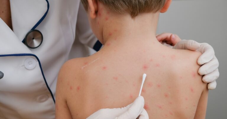 Brote de sarampión: advierten por la baja concurrencia para aplicarse las vacunas